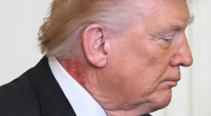 ಅಮೆರಿಕದ ಅಧ್ಯಕ್ಷ ಡೊನಾಲ್ಡ್ ಟ್ರಂಪ್ ಆರೋಗ್ಯಕ್ಕೇನಾಯ್ತು, ಕುತ್ತಿಗೆ ಮೇಲೆ ಕಾಣಿಸಿಕೊಂಡ ಕೆಂಪು ಕಲೆ